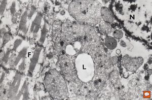 M, 7w. | mitochondrial cardiomyopathy … (N … nucleus, F … myofilaments,L … lipid droplets surrounded by megamito M, 7w. | mitochondrial cardiomyopathy … (N … nucleus, F … myofilaments,L … lipid droplets surrounded by megamito
